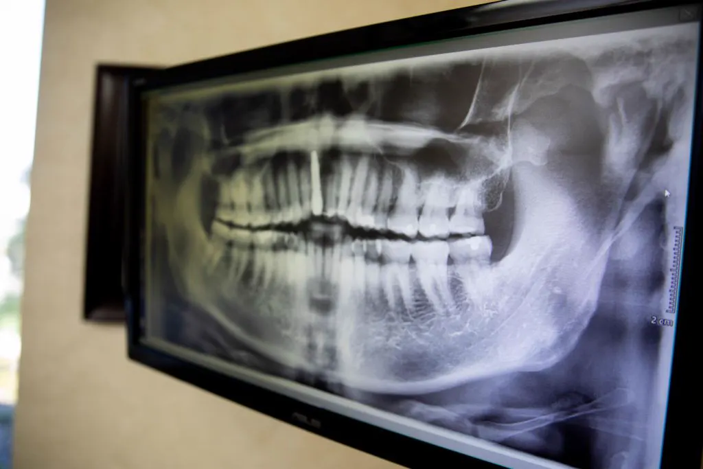 Digital panoramic X-ray displayed on a monitor in our office